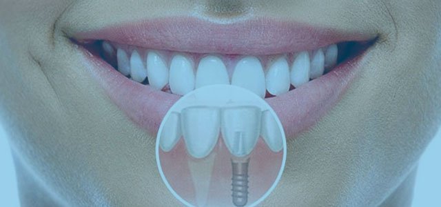 Dentalnaya implantaciya
