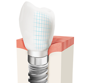 teeth implant