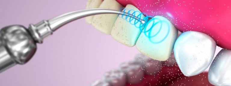 ultrazvukovaya chistka zubov 1